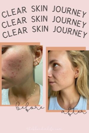 FINAL UPDATE: Clear Skin Journey - The Blonder Life